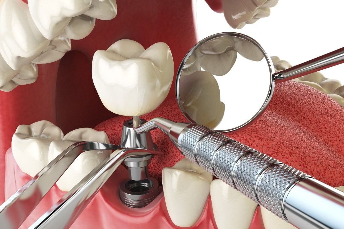Cirugia Implantes Cirugia Oral Vilchez